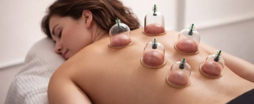 Ventouses : une technique ancestrale pour libérer les tensions et retrouver l’équilibre