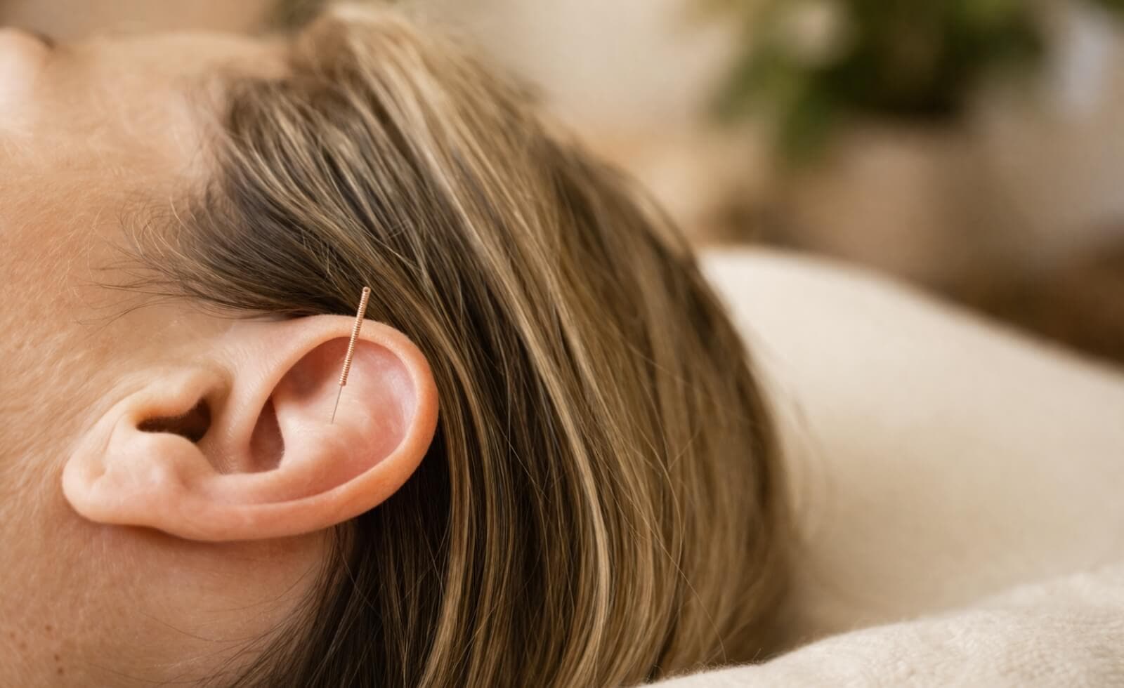 L'acupuncture pour réguler le cortisol _ comment ça fonctionne concrètement